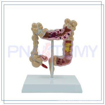PNT-0745 Diseased large intestines